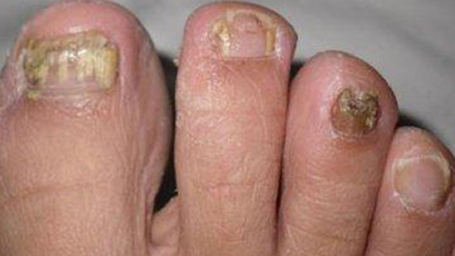 惊讶到我了！灰指甲居然就这么没了！