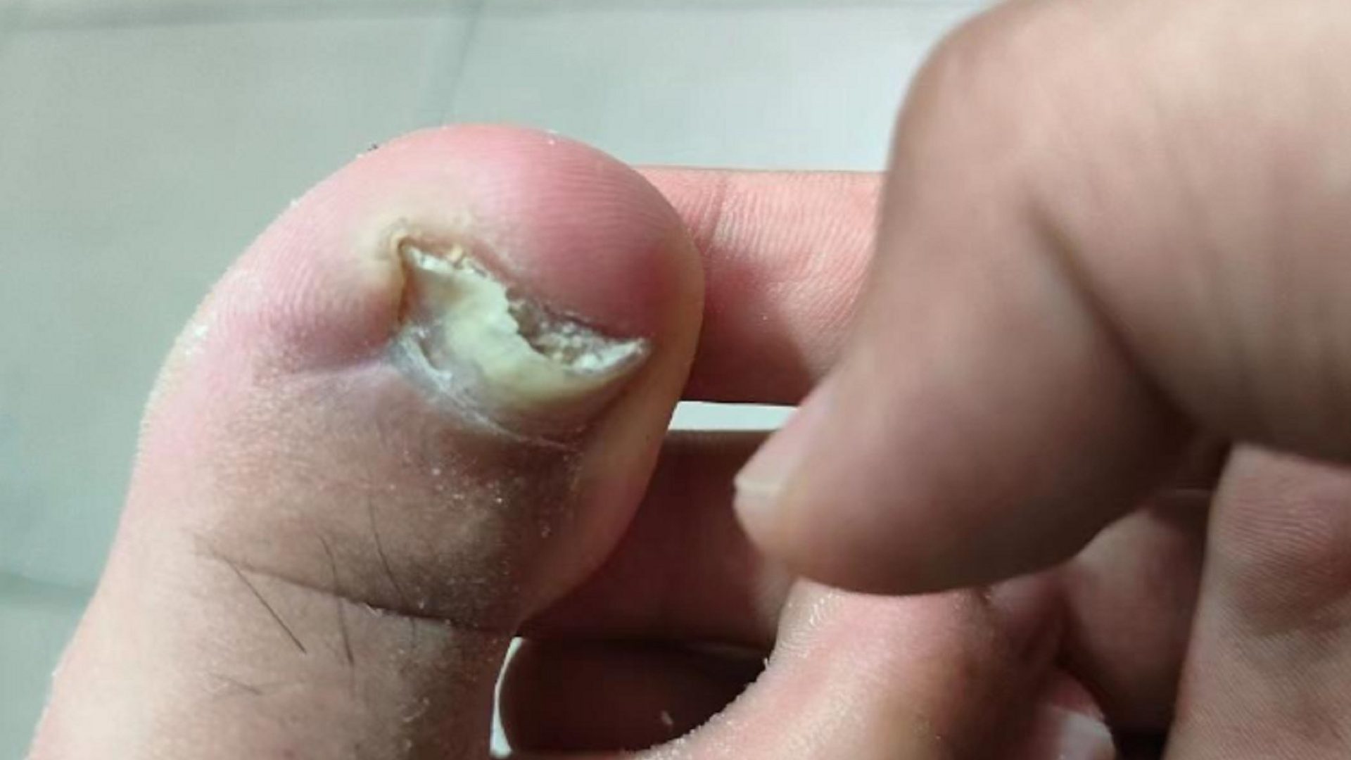 灰指甲一个传染俩！这个祛灰妙招赶快用！杀菌修复不反灰！