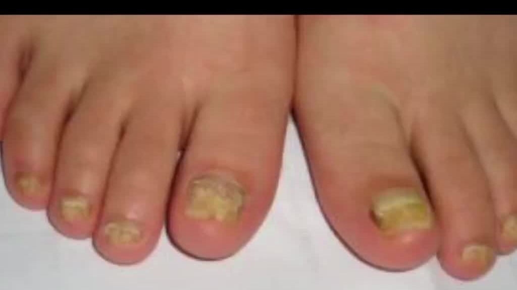 偏方真能治疗灰指甲吗？