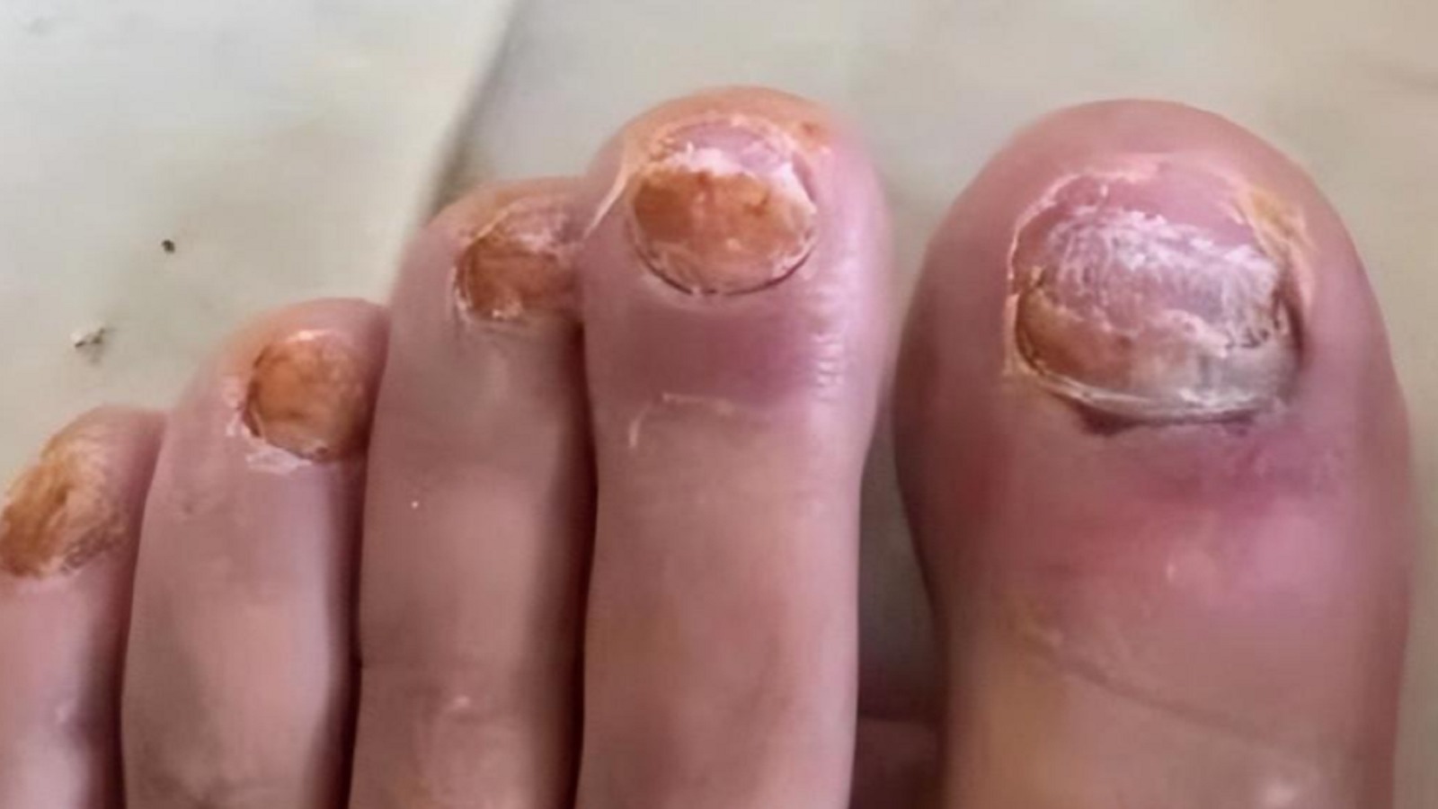 得了灰指甲用什么药最有效？过来人3款实测！便宜安全又有效！