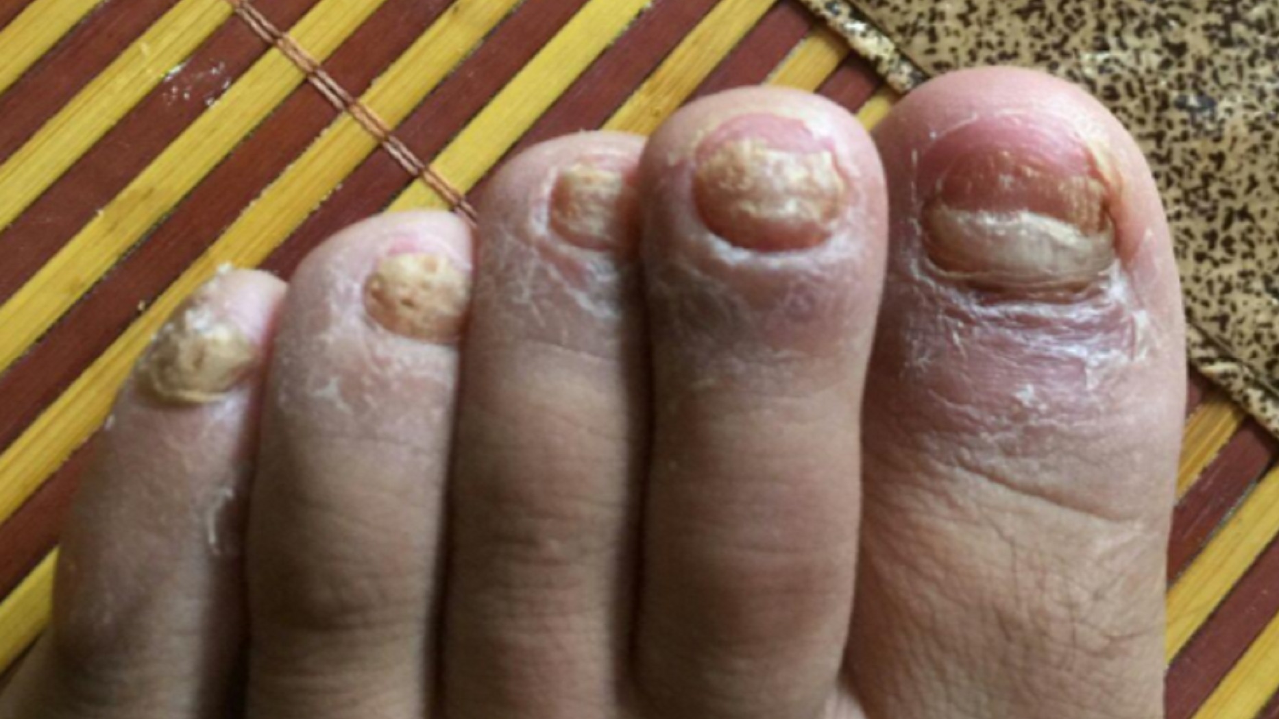 灰指甲成功上岸！经验分享！