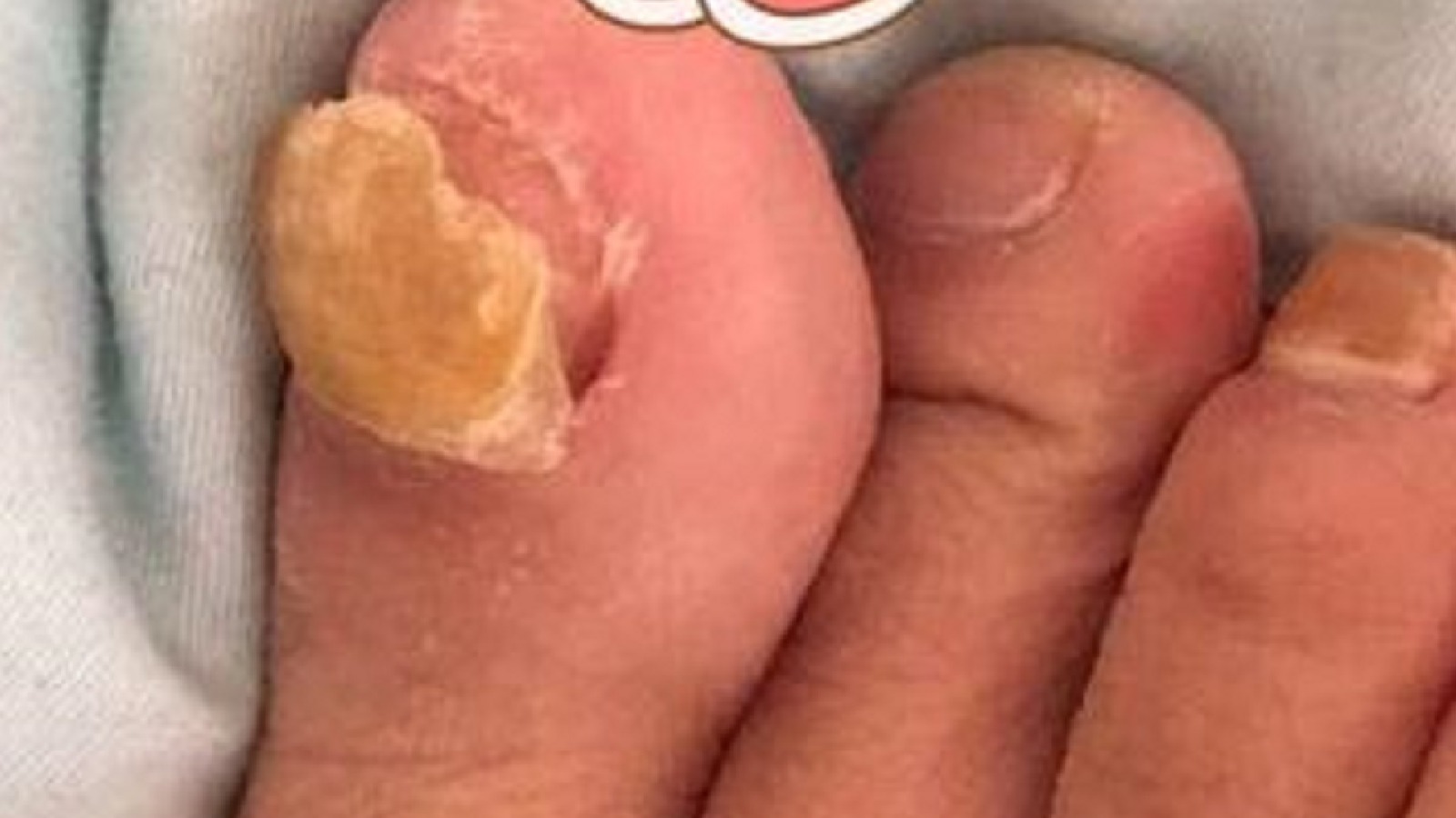 国货祛灰药物大测评！任用一个，灰指甲在家轻松摆脱不复发！