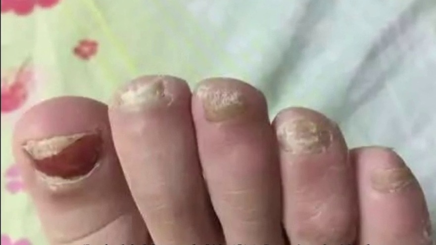 顽固灰指甲一次性根除！方法附上
