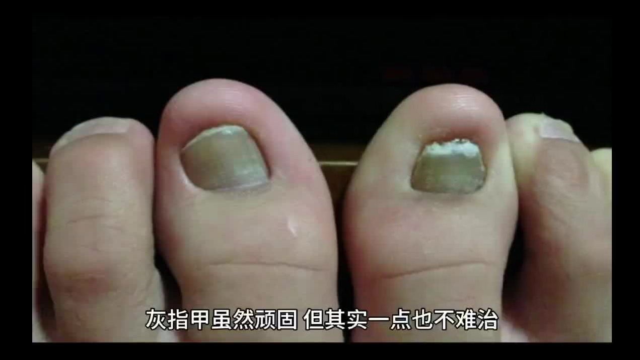 灰指甲别乱用偏方！一个方法教你解决！