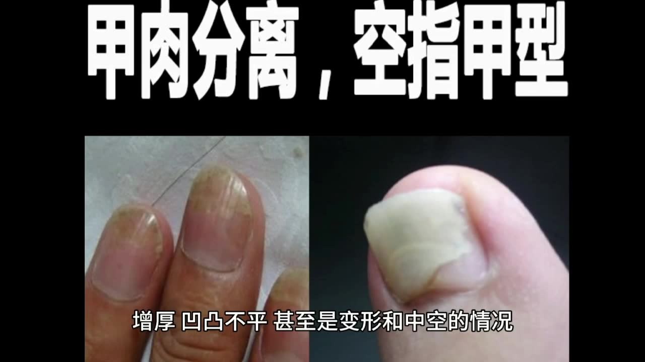 指甲发黄增厚还变形？一招教你解决！