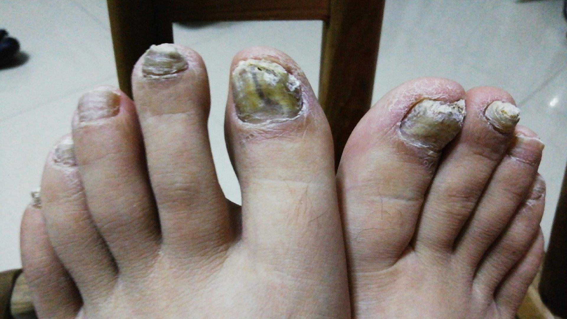 灰指甲反复发作太难治？学会这一招，在家轻松搞定不复发！