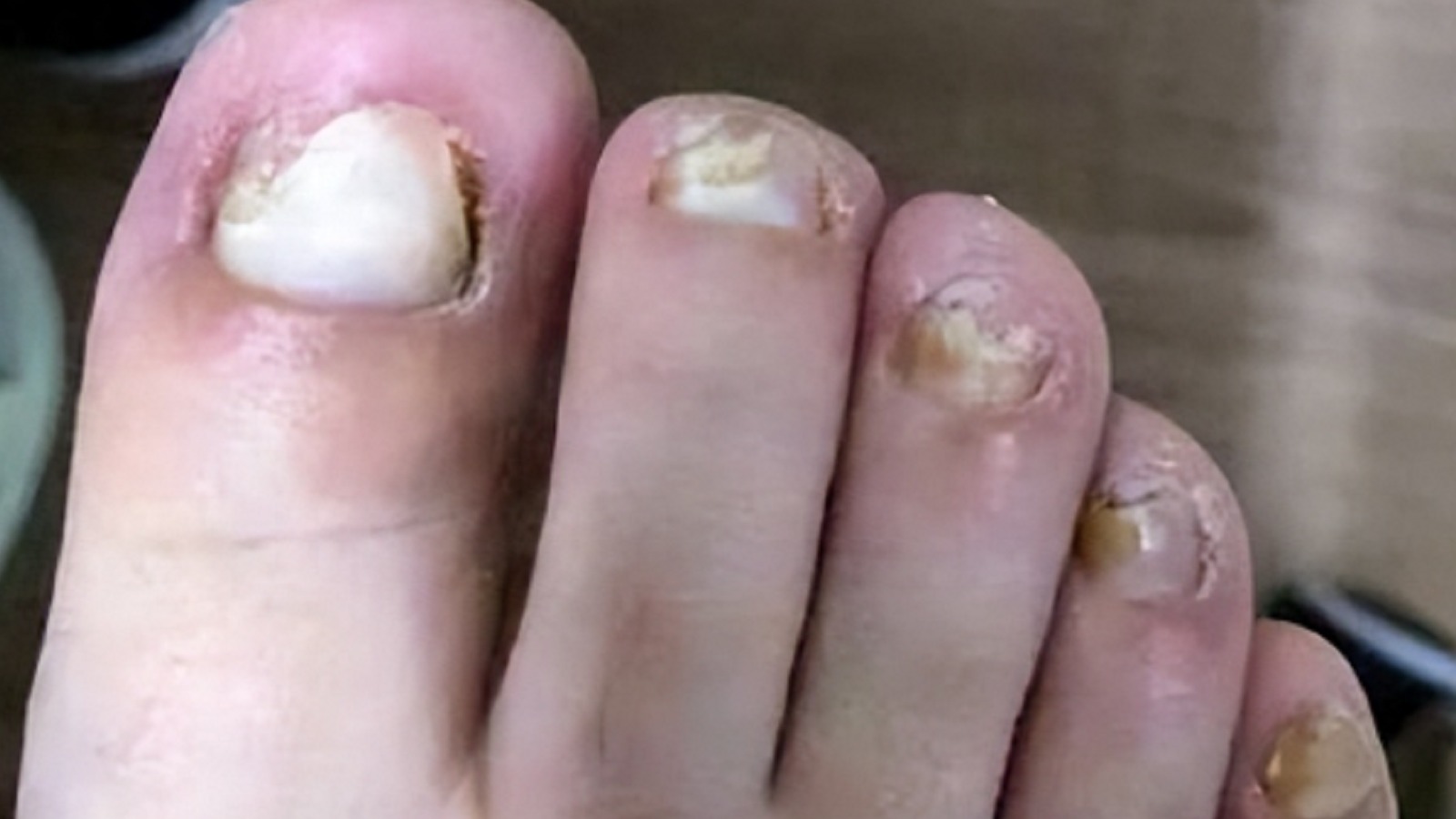 4款自用抑菌药物大测评！谁才是国货之光？顽固灰指甲轻松拿下！