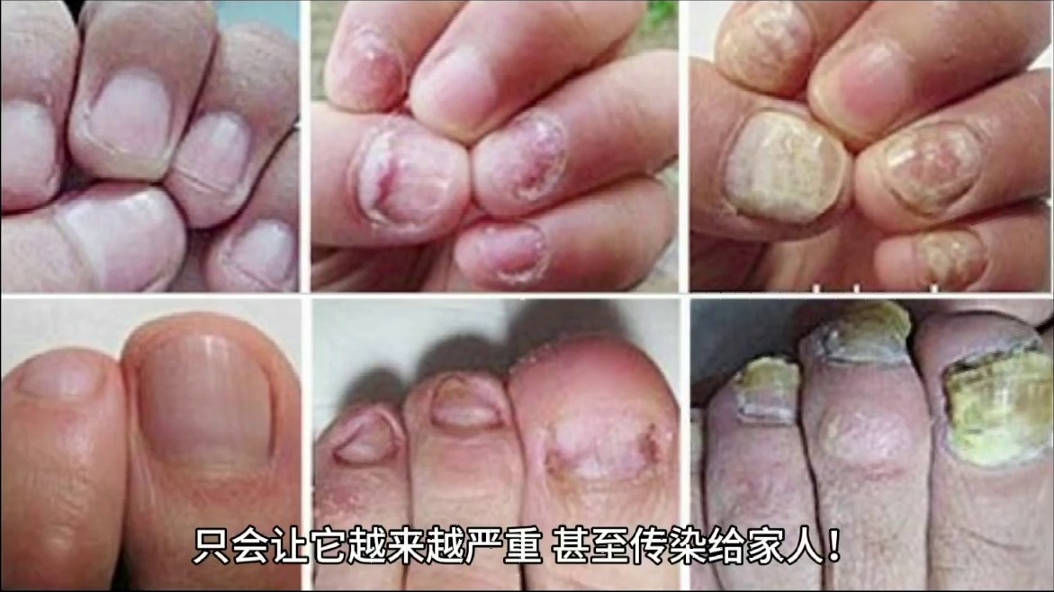 指甲增厚浑浊还变形？一招教你拯救！