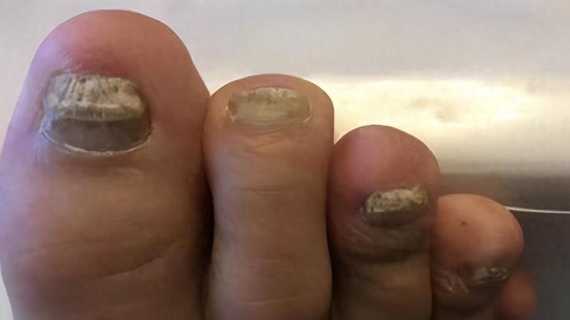 夏季真菌感染高发！学会这3招，在家轻松摆脱灰指甲！