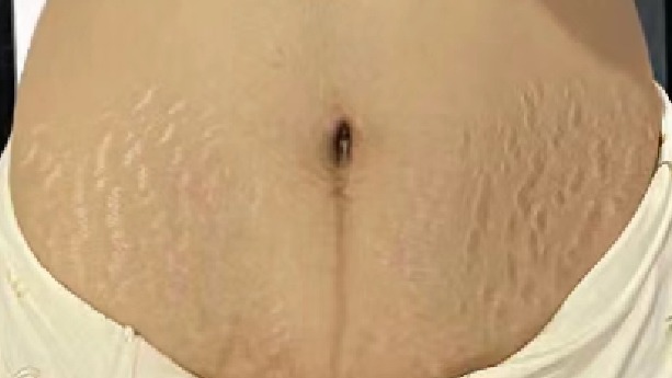 多年妊娠纹还有救吗？二胎宝妈分享自用秘籍！红白纹统统拿下！