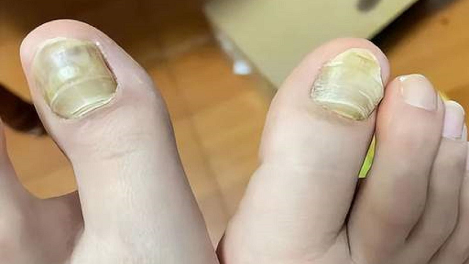 灰指甲还不知道怎么治？医学生在线支招！坏甲秒变健康新甲！