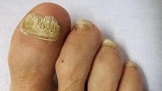 指甲增厚泛黃還易傳染？！康復(fù)者無償分享祛灰秘籍！病甲變亮甲！