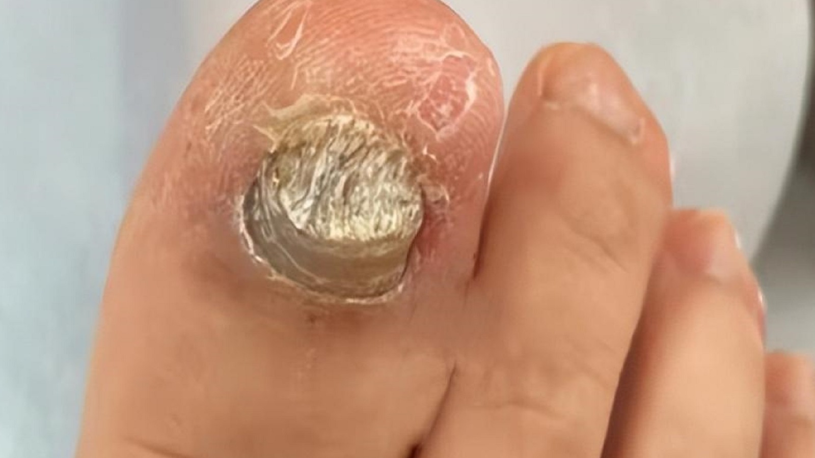 天一热真菌又活跃！分享几个亲测有效的祛灰妙招！快速杀菌断根！