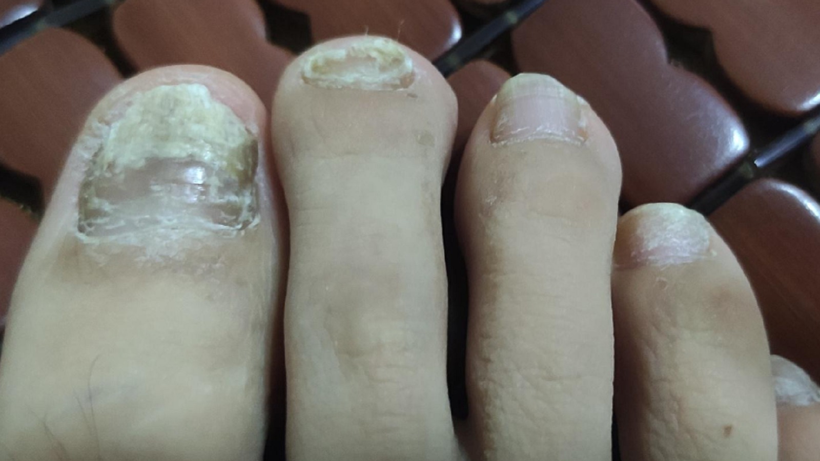 康复者分享3款自用祛灰产品！精准祛灰不反复！用了都说好！