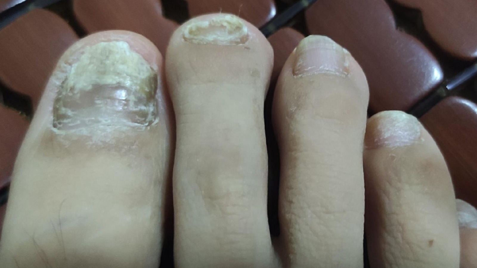 万众期待的灰指甲药物大测评！真人实测！30天坏甲刷刷掉！