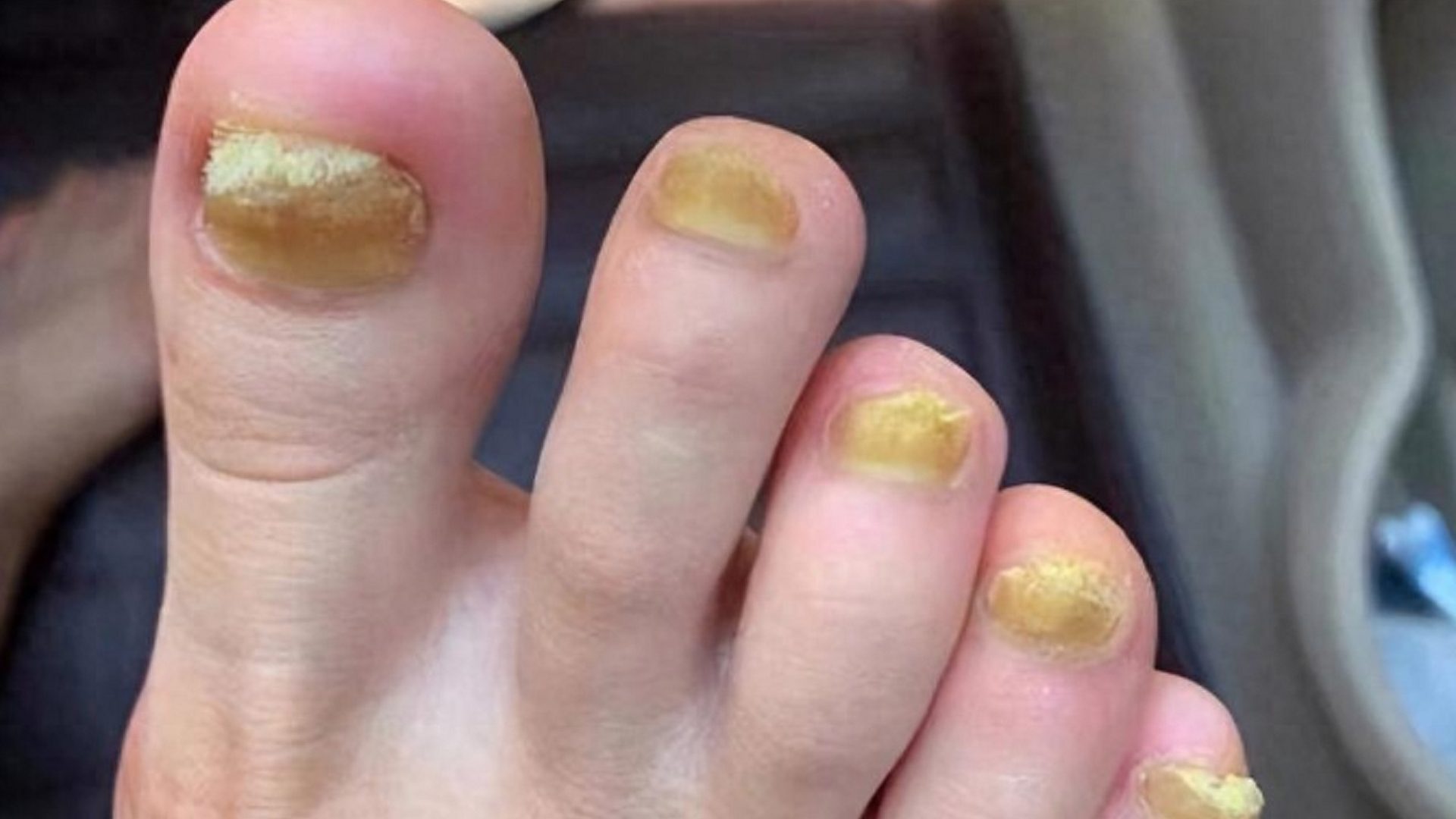 得了灰指甲怎么治？这个方法安全效果好！每天几分钟灰指甲去无踪