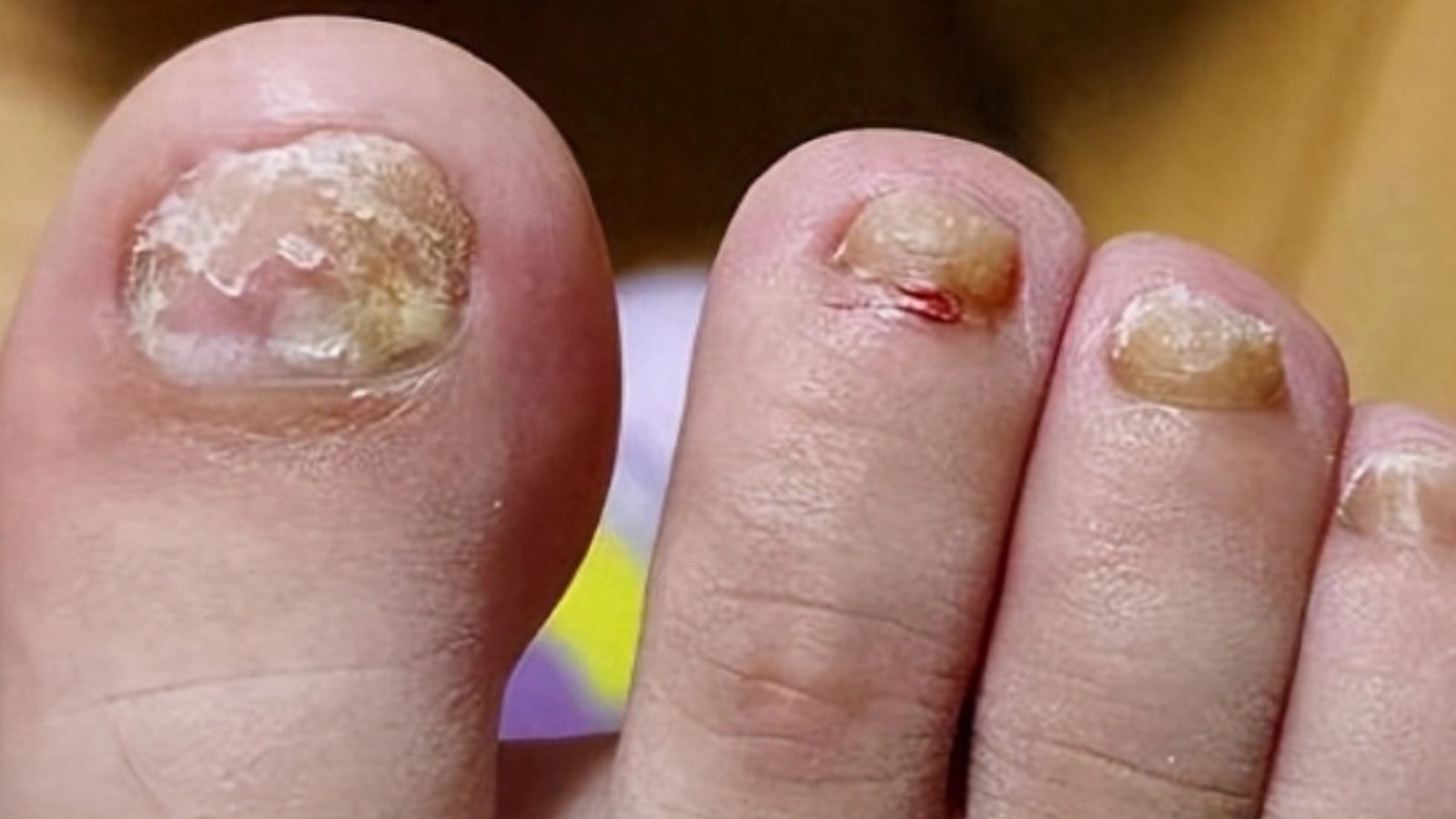 真菌感染的灰指甲如何用药？过来人4款实测，不看就真的错过了！
