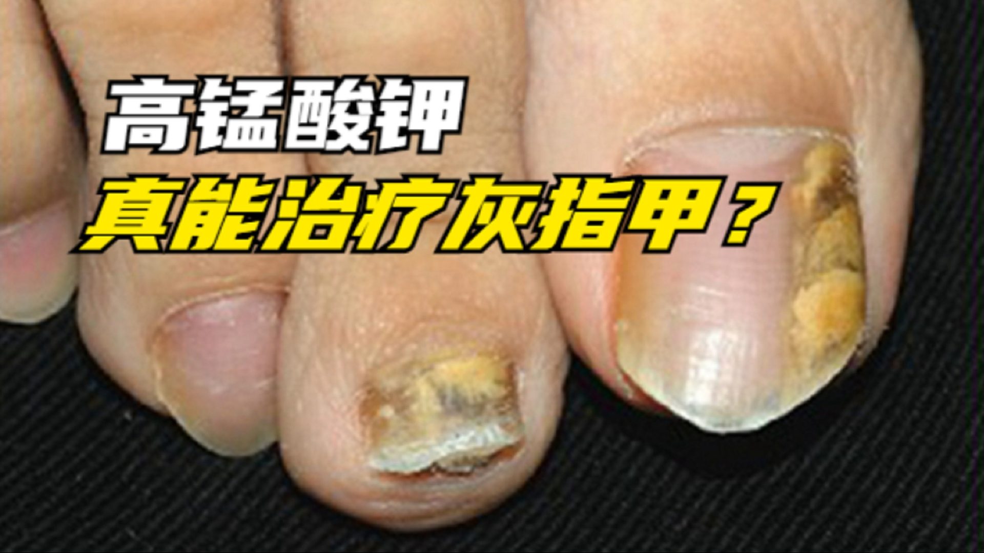 高锰酸钾真能治疗灰指甲？过来人亲测，效果惊掉我下巴！