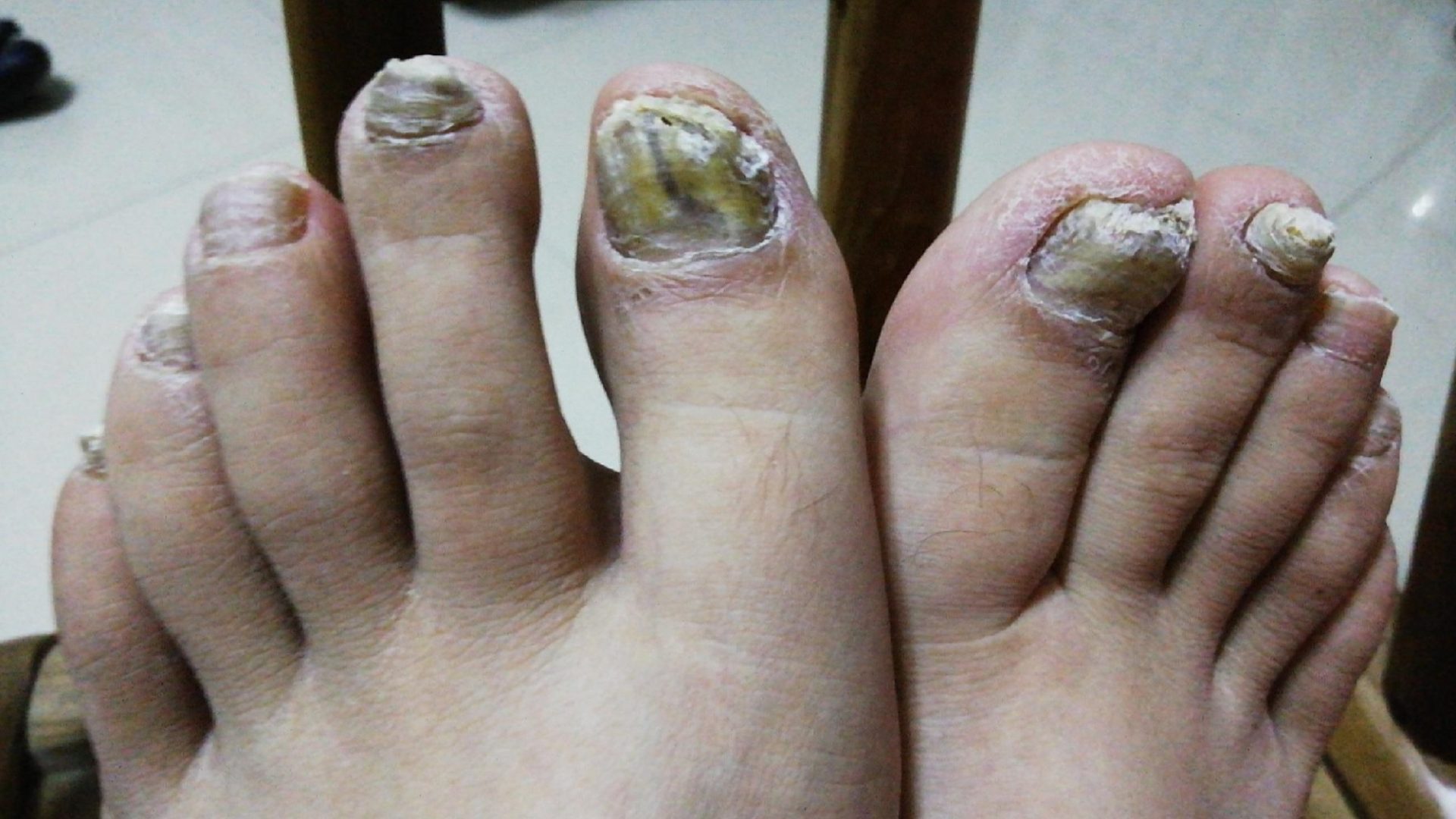 别再乱用偏方了！学会这3招，低成本在家解决灰指甲！