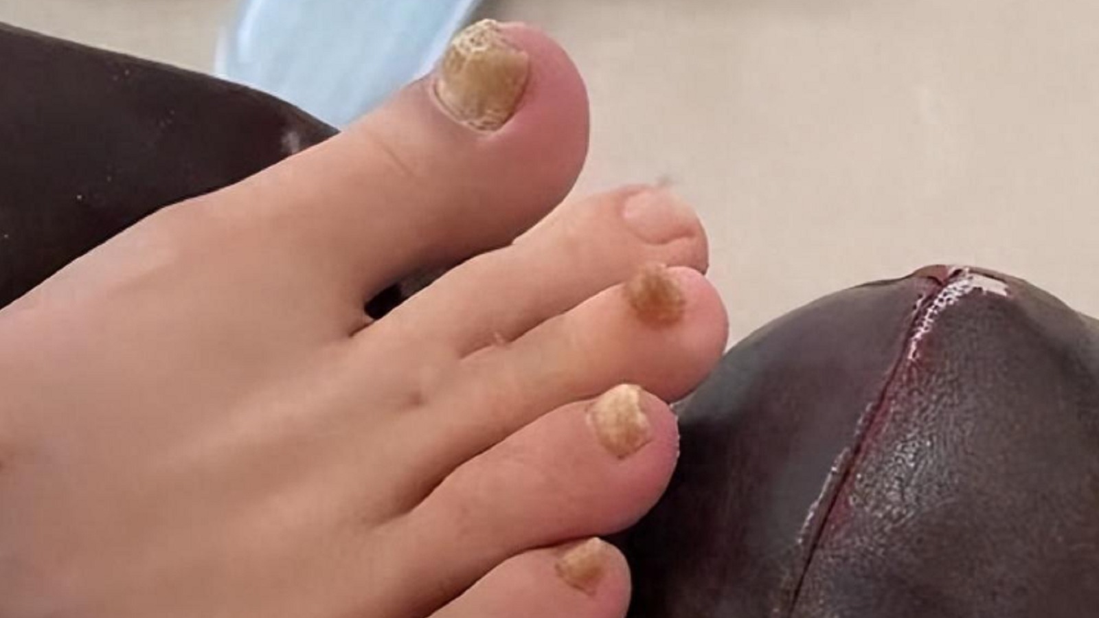 5年顽固灰指甲成功解决！治疗经验无偿分享！学到就是赚到！