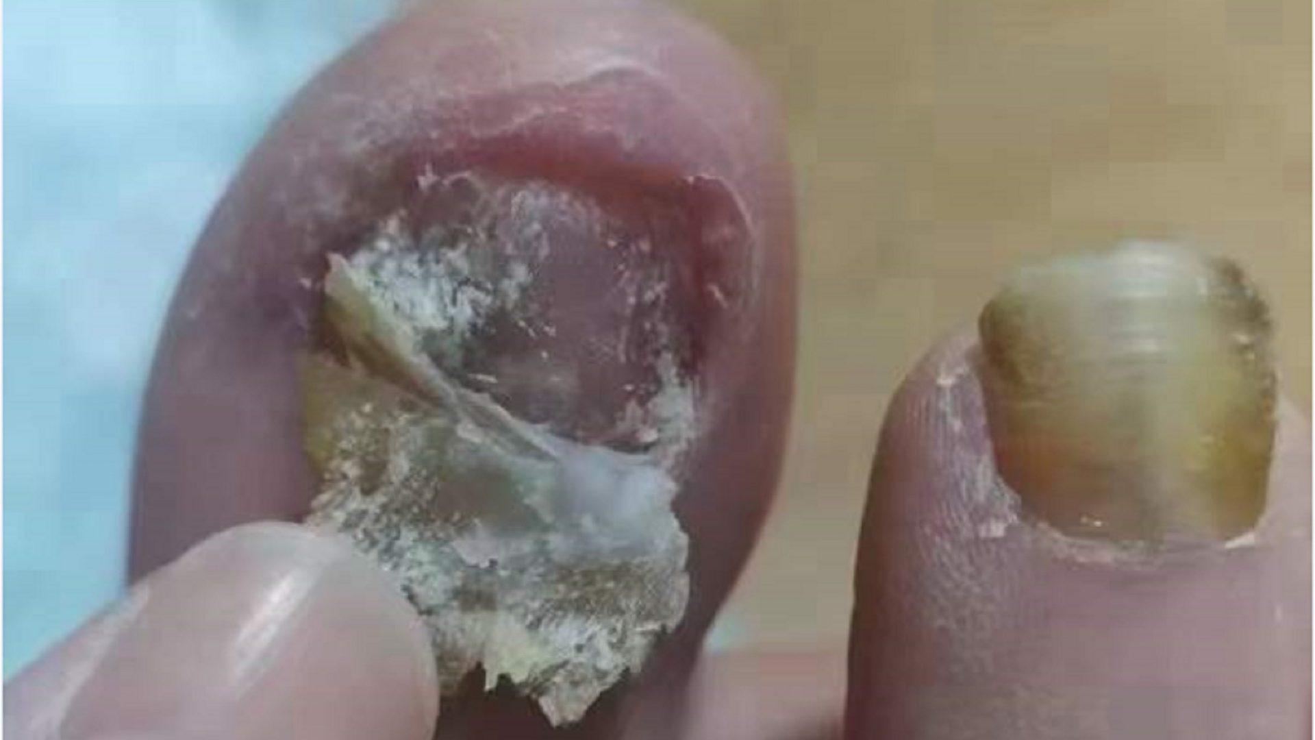 指甲增厚甲内中空？学会这招，多年顽固灰甲也能变亮甲！