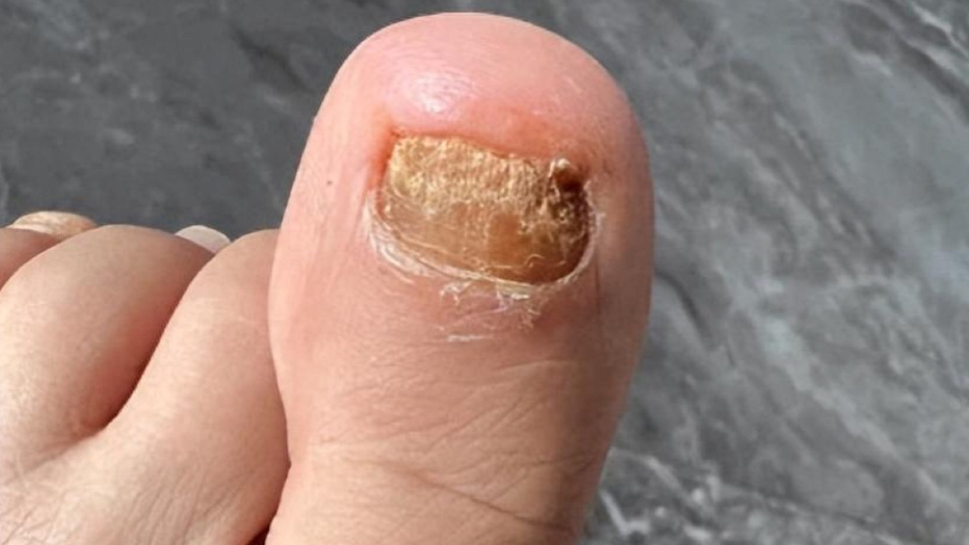 能帮一个是一个！解决灰指甲别花冤枉钱了！