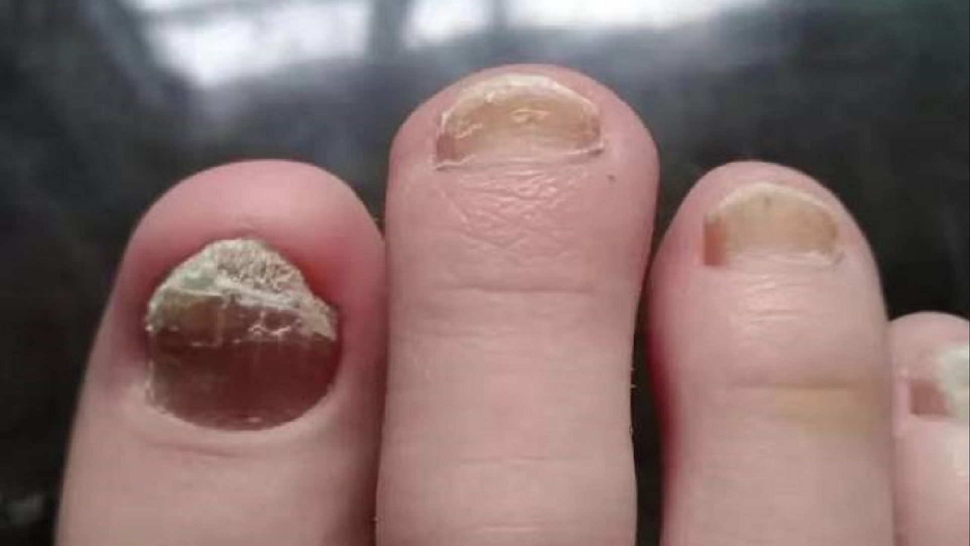 国内外祛灰产品大测评！效果最好的竟是它？！灰指甲病友必看！