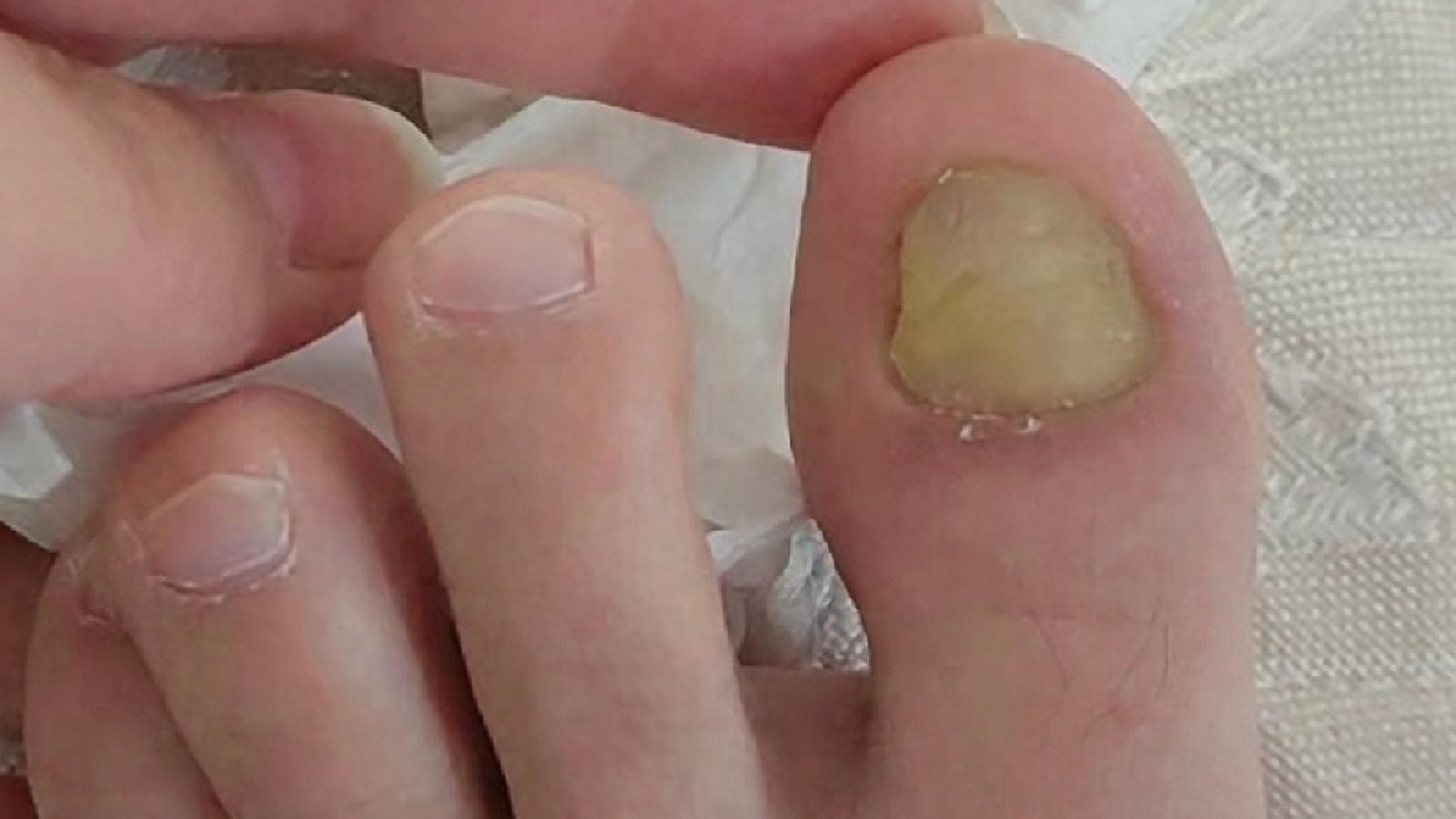 指甲浑浊发灰要警惕！这是真菌在作怪！3个妙招让你1次解决！