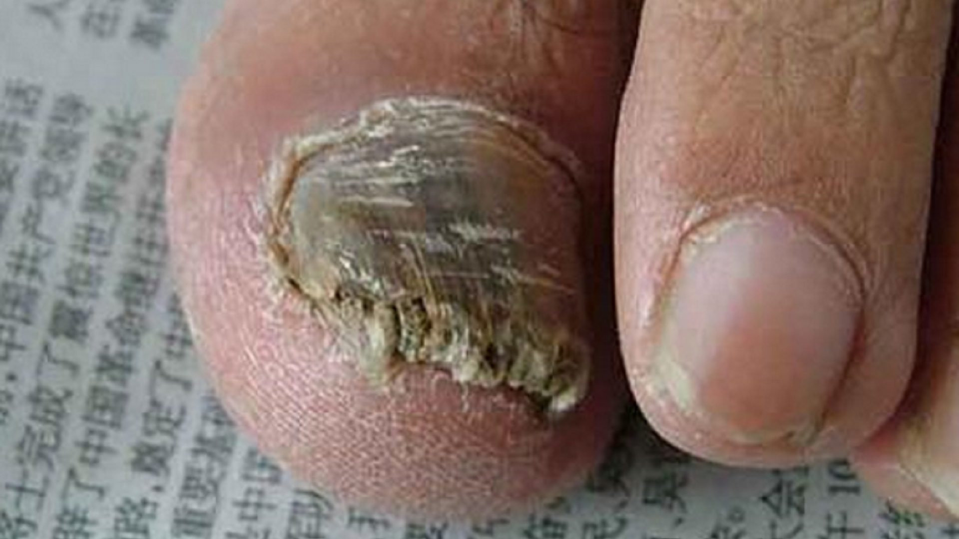 灰趾甲又厚又硬怎么办？不妨试试这3招！杀菌修复不反灰！