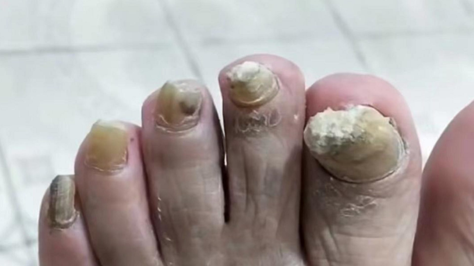趾甲增厚分层怎么办？康复者曝光自用疗法，灰趾甲秒变亮甲！