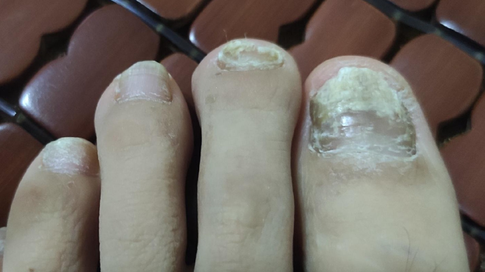 灰指甲省钱根治攻略！过来人亲测有效！每天成本几毛钱！