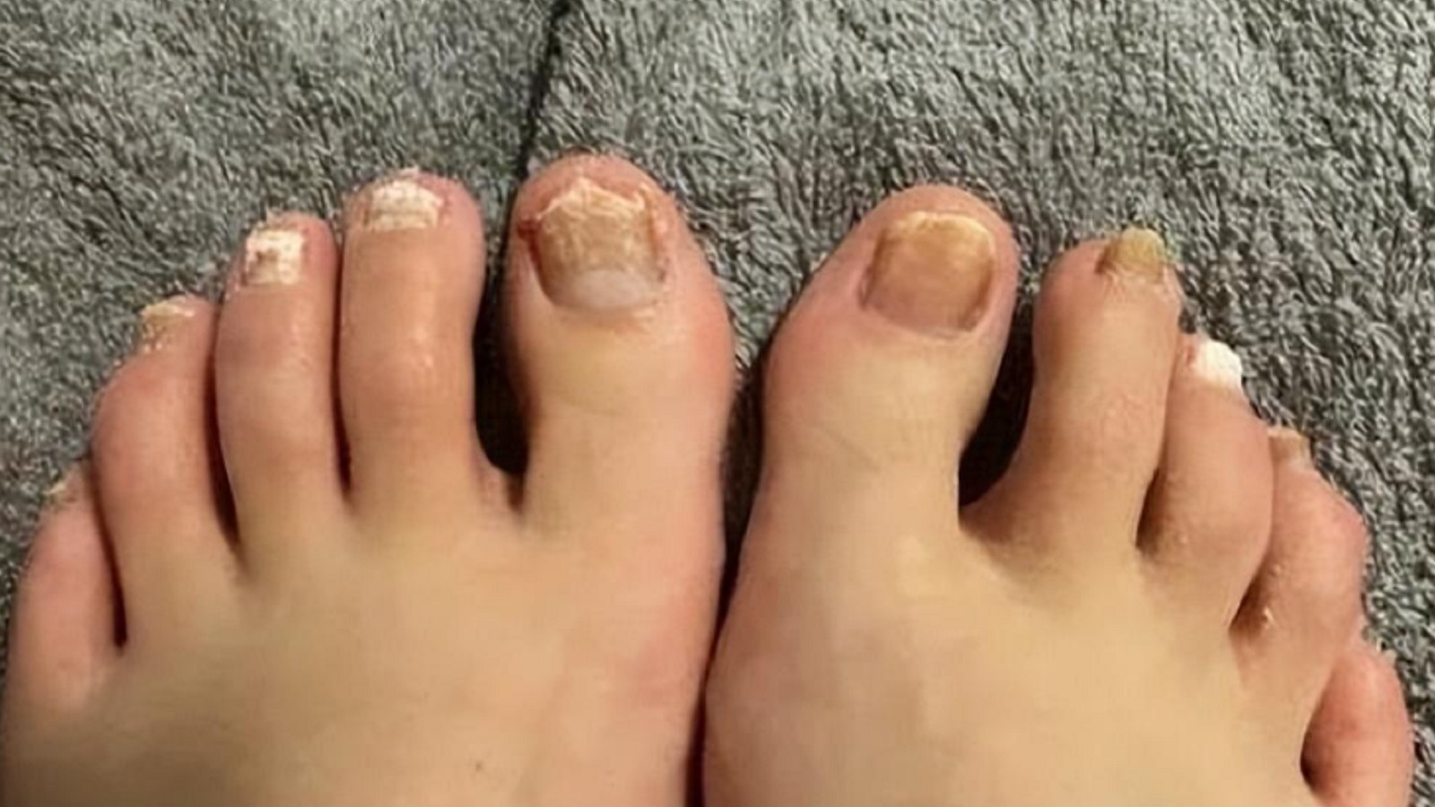 得了灰趾甲怎么治？学会这招，顽固病甲在家根除！