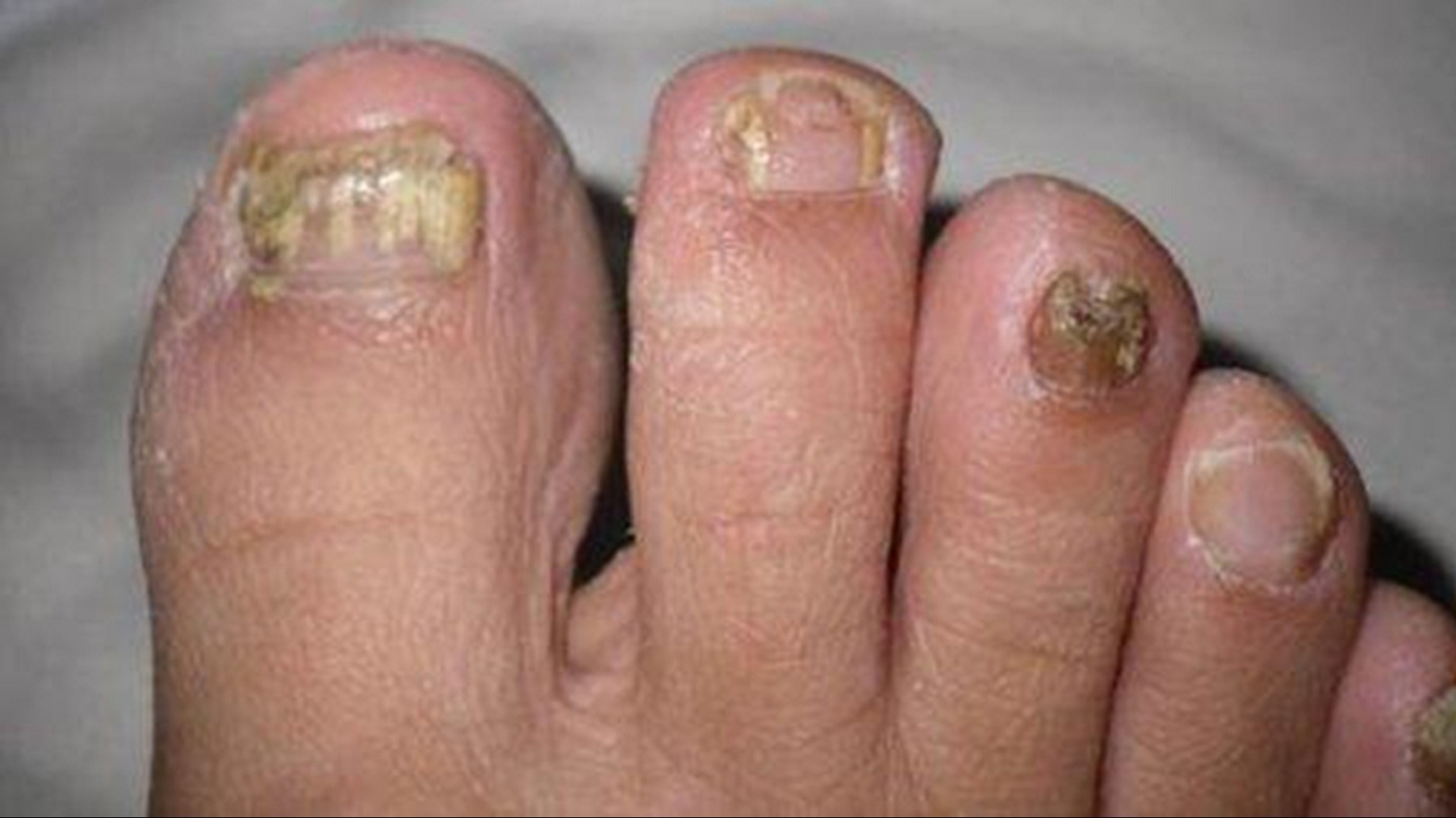 灰趾甲终于没了！血泪经验分享！