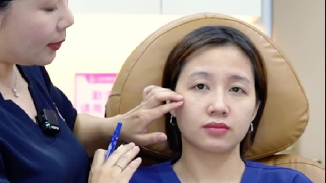 垮脸自救！法令纹 鼻基底凹陷 填充不踩坑