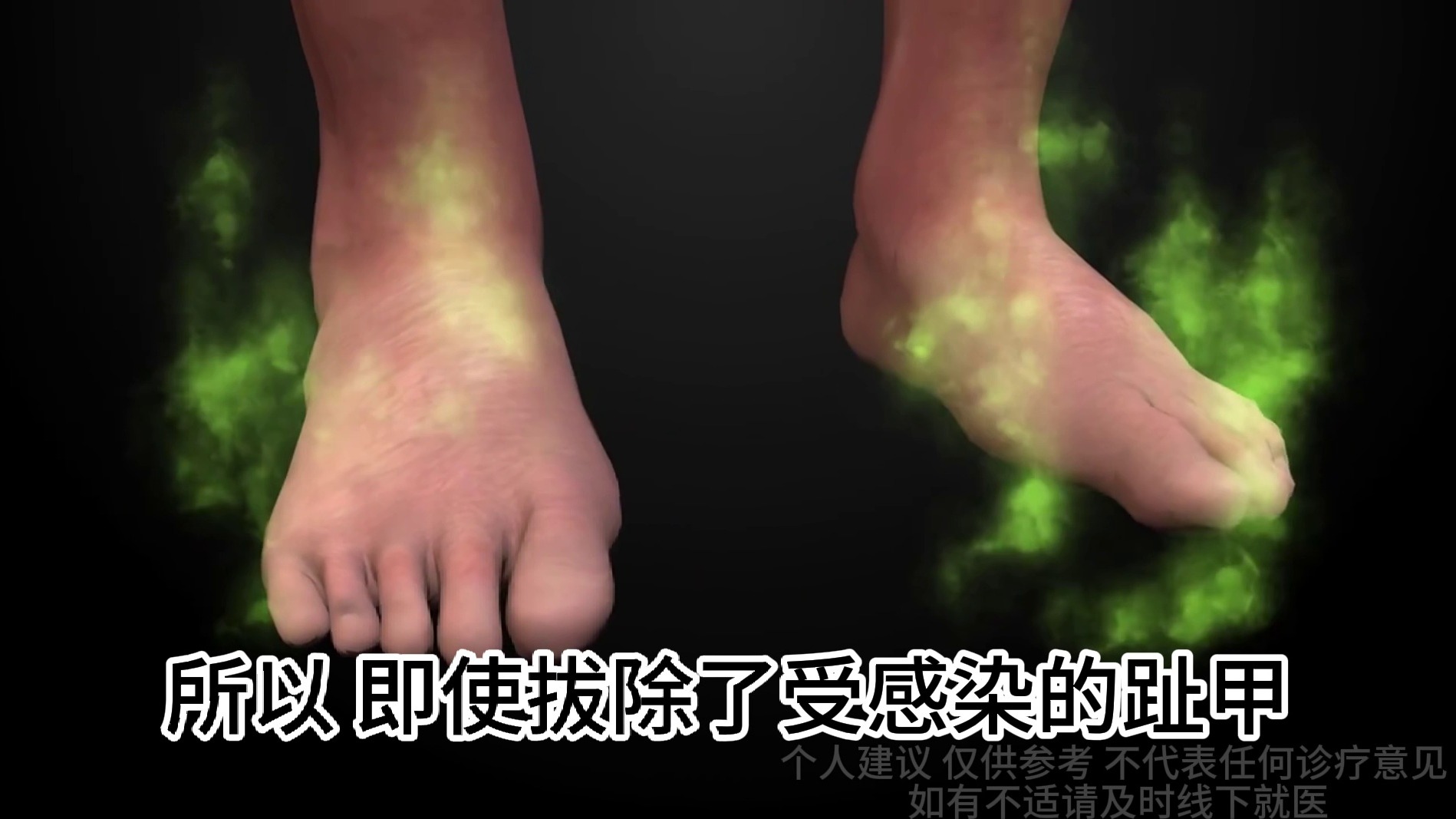 灰趾甲终于没了！过来人血泪经验分享！