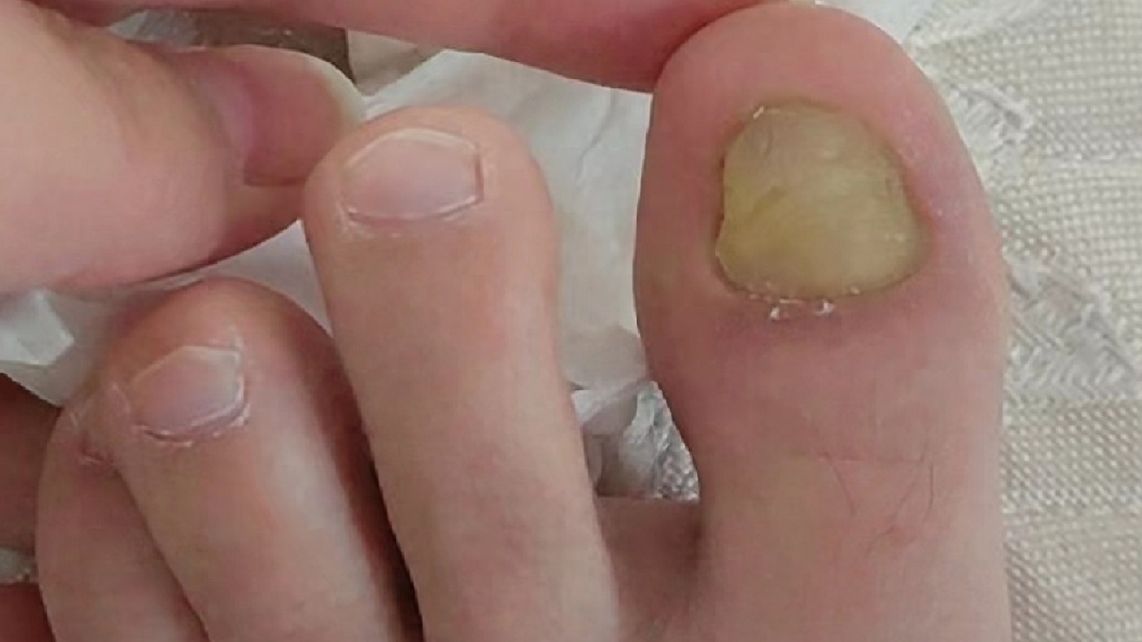 灰趾甲真的很难治吗？过来人教你在家解决！