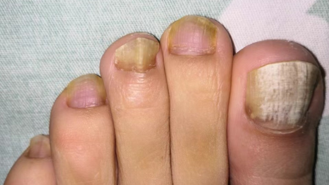灰趾甲怎么治才能根除？过来人强推三个方法！获专家点赞！