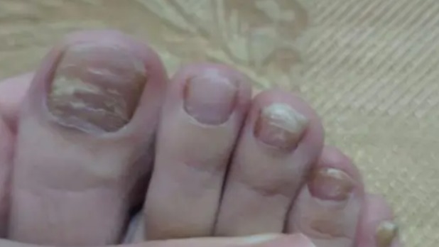 得了灰趾甲不知道该用什么药？过来人亲测分享！杀菌修复不反灰！