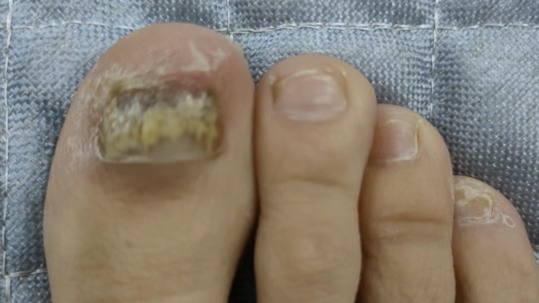 一分钟教你彻底根治灰趾甲！看完少花冤枉钱！坏甲唰唰掉！