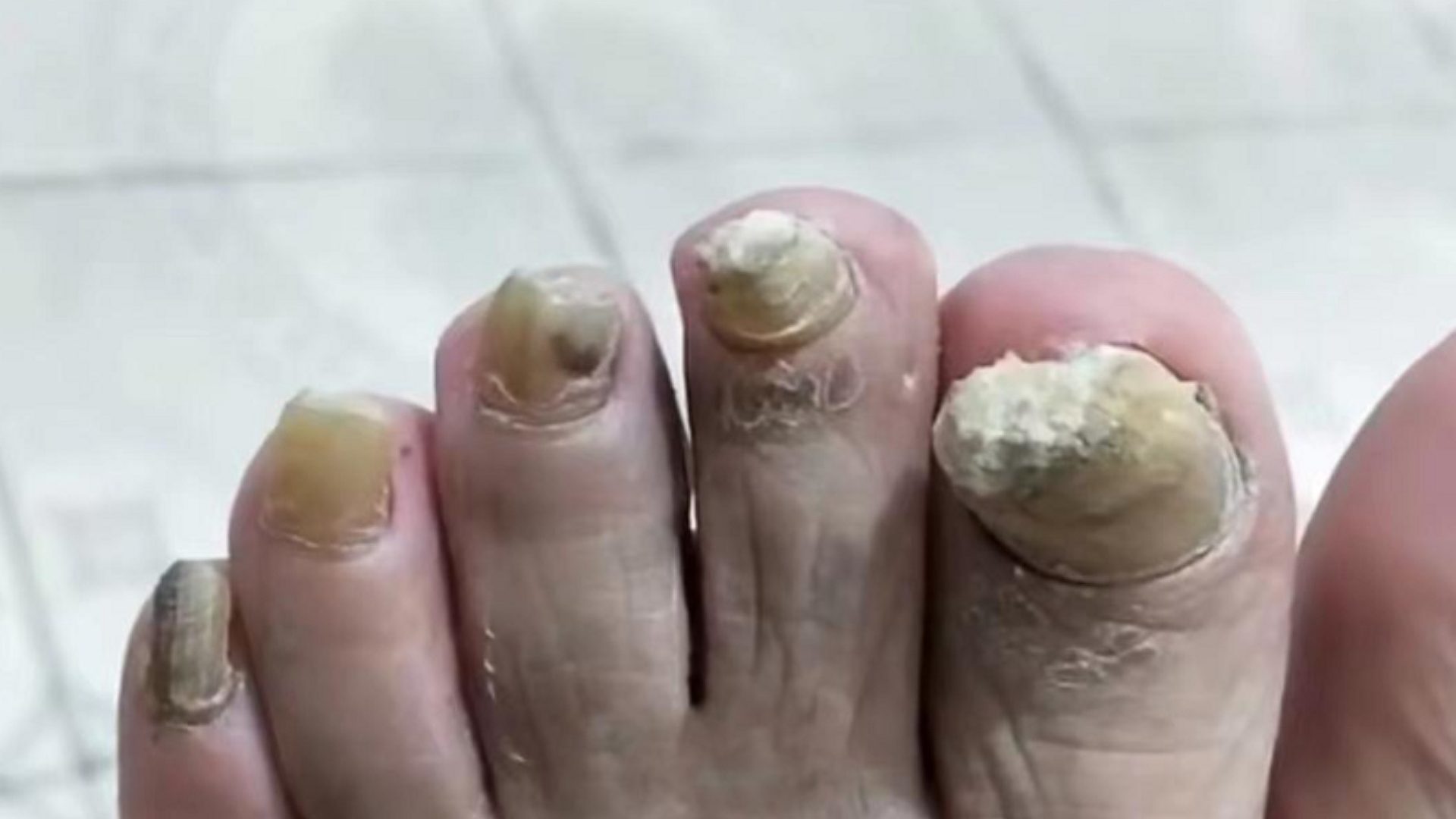 灰趾甲有根治的可能吗？