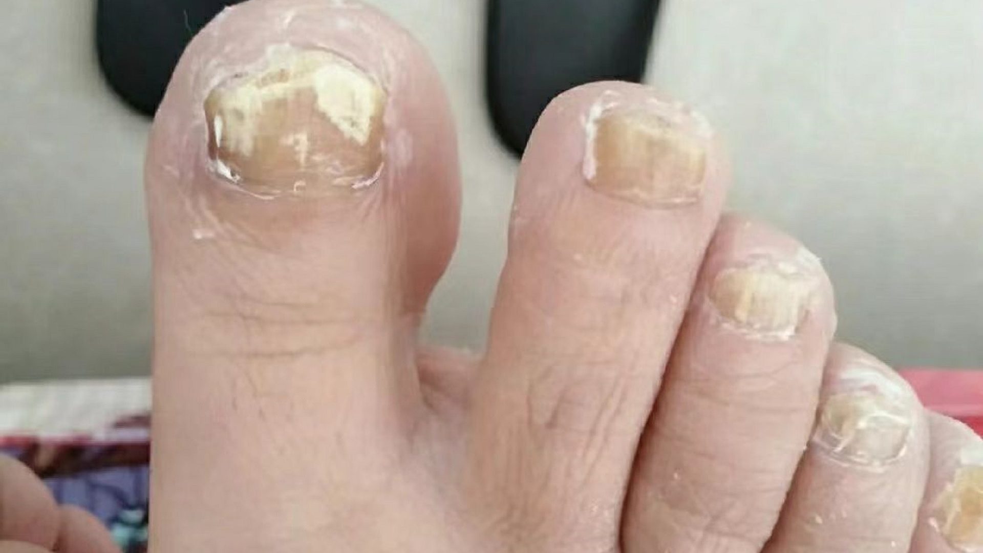 速看！灰趾甲康复者亲测有效的祛灰秘籍大公开！学会立省大几千！