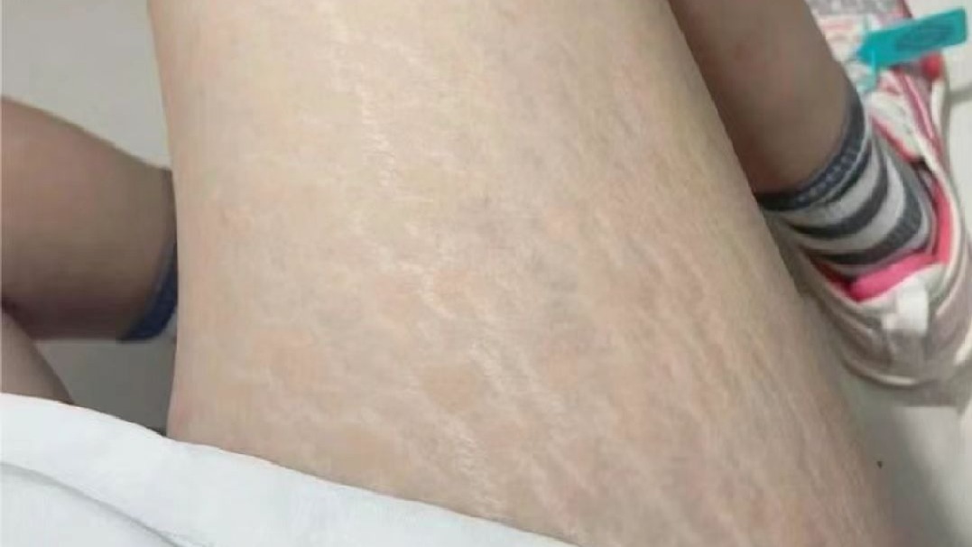 肥胖纹变白是在消失吗？大漏特漏！过来人一个方法教你解决！