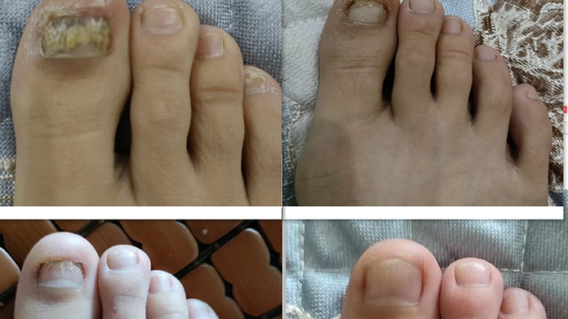 灰趾甲好了！高锰酸钾还有这作用？！