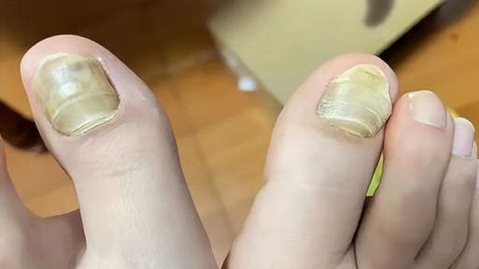 灰趾甲抑菌药物大测评！不想花冤枉钱的赶紧看！在家轻松祛灰！