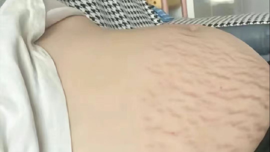 产后妊娠纹怎么去除？过来人手把手教学！直接剩下大几千！