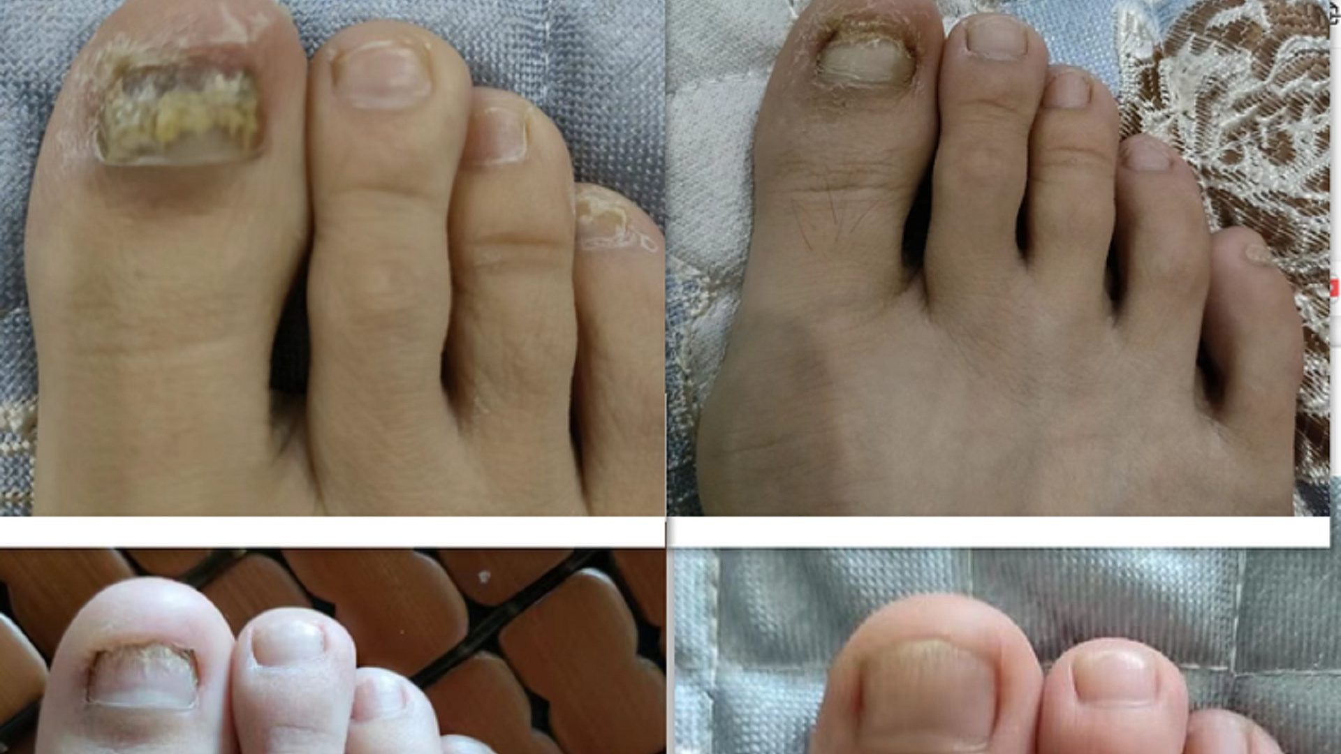 灰趾甲怎么治啊？我的血泪经验分享！赶紧码住！