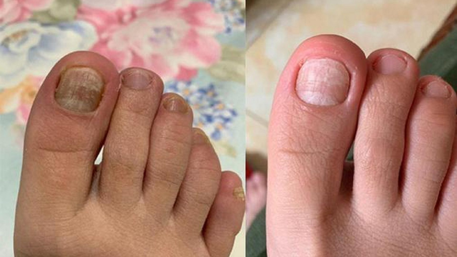 祛灰产品怎么选？过来人亲测分享！杀菌修复不反灰！