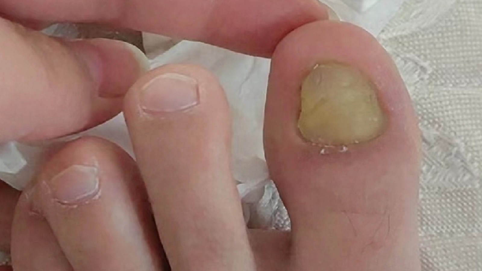 天一热灰趾甲就复发？那是真菌没除彻底！3个实用方法教你解决！