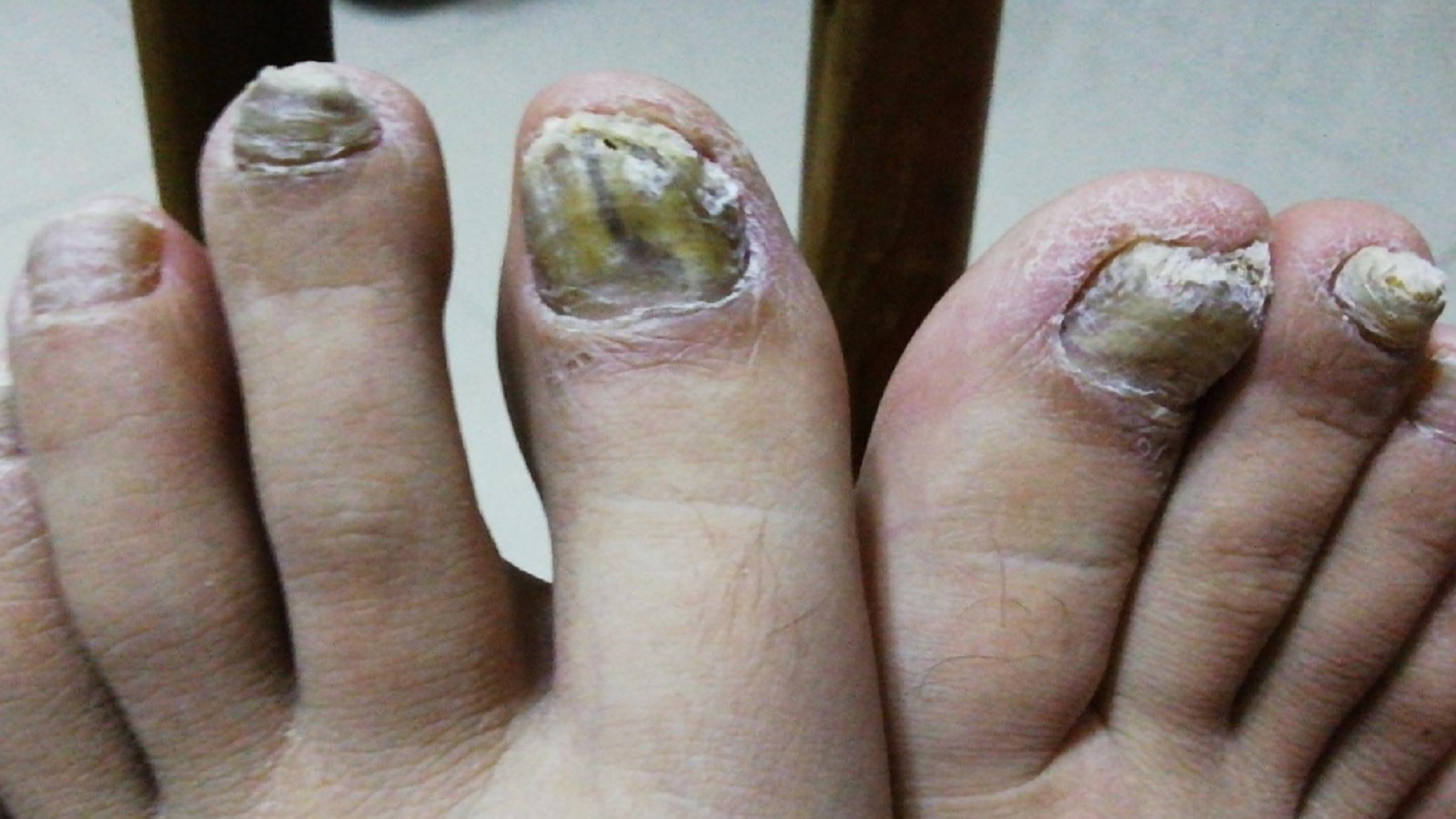 历时4个月，灰趾甲终于没有再复发了！