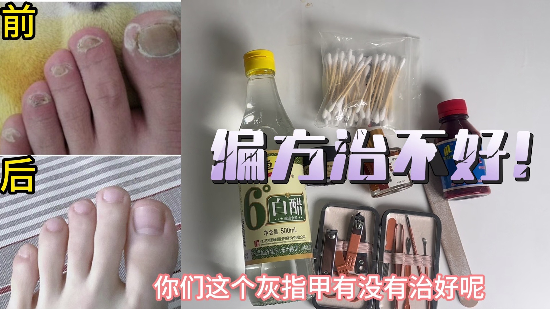 灰趾甲别乱用偏方了！学会这个妙招，多久的灰趾甲都能轻松根治！